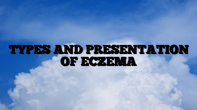 TYPES AND PRESENTATION OF ECZEMA